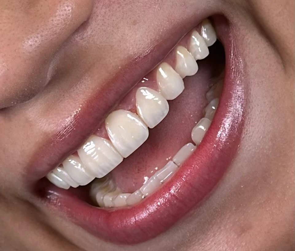 Sorriso de uma paciente real da Dra. Luana Lima